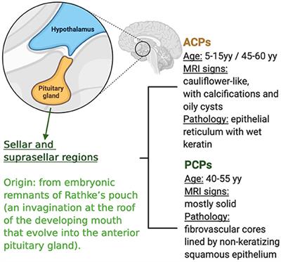 Dramatic Therapeutic Response to Dabrafenib Plus Trametinib in BRAF V600E Mutated Papillary Craniopharyngiomas: A Case Report and Literature Review